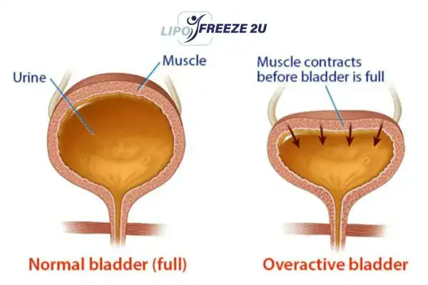 diagram of overactive bladder treatment Leigh-on-Sea
