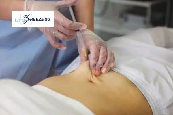 How Does Aqualyx Fat Dissolving Injection Work to Break Down Fat Leigh-on-Sea?
