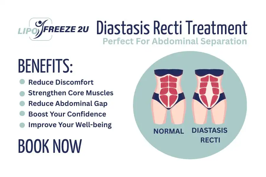 Benefits of body toning treatment Leigh-on-Sea for Diastasis recti