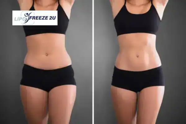How Can LIPO FREEZE 2U Support Your Post-Pregnancy Body Recovery Leigh-on-Sea?
