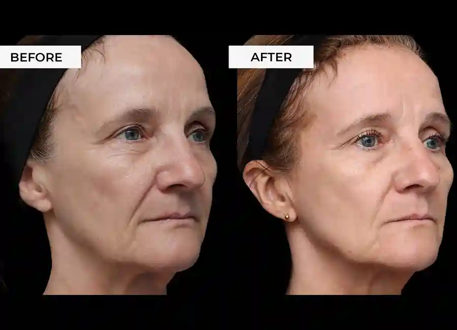 How Many RF Microneedling Sessions Will You Need to See a Difference Leigh-on-Sea?