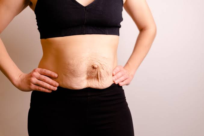 Is Surgery Really the Only Way to Repair Diastasis Recti Leigh-on-Sea?