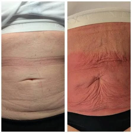 How Does RF Microneedling Improve Crepey, Thin and Uneven Skin Texture Leigh-on-Sea?