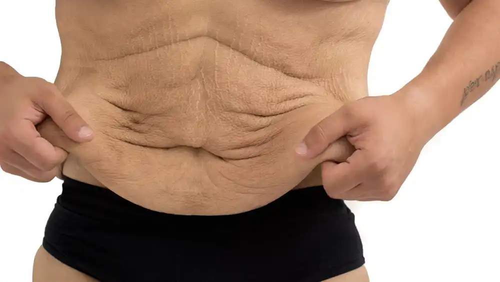 Why Does Weight Loss Medication Leave Some People With Loose or Sagging Skin Leigh-on-Sea?